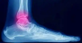 An update on the diagnostic techniques for ankle torque-related fractures