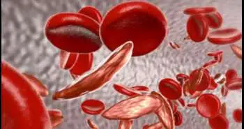 Acute Vaso-Occlusive pain at menstruation onset in women with sickle cell disease (SCD) has proven association