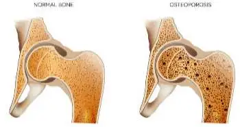 Zoledronic acid (ZOL) proved to be an effective alternative to odanacatib (ODN) in treating postmenopausal women with osteoporosis