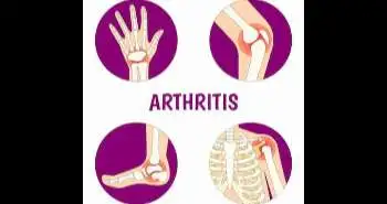 Crystal-associated arthritis improved significantly by Anakinra