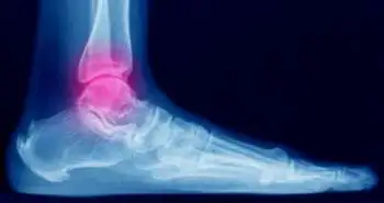 Suture fixation of acute disruption of the distal tibiofibular syndesmosis