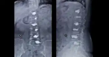 Bone cement distribution and volume found to be a major risk for secondary new vertebral compression fractures (SNVCFs)