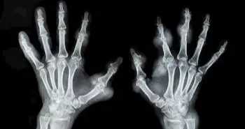 Anti-oxidant adjuvant therapy found to manage rheumatoid arthritis better