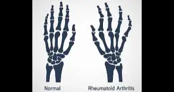 Low disease activity after Adalimumab discontinuation for up to 3 years in early rheumatoid arthritis