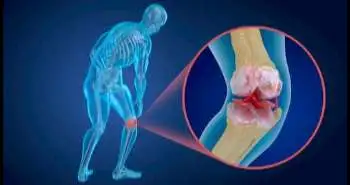 A study estimated longitudinal use of intra-articular injections after treatment start in knee OA patients