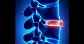 Two different tools compared to assess osteoporotic vertebral fractures