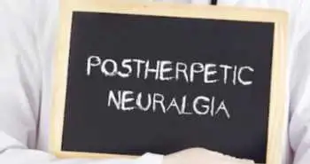 Local administration of methylcobalamin for subacute ophthalmic herpetic neuralgia