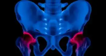 Modified trapdoor procedures are better than light bulb procedures for osteonecrosis of the femoral head treatment