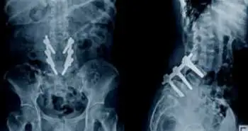 Repeat anterior versus posterior decompression and fusion in two-level symptomatic adjacent segment disease treatment following anterior cervical arthrodesis