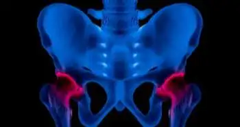 Opioid-related adverse events of intravenous oxycodone and morphine following total hip arthroplasty compared