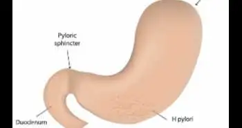 Study evaluates safety and efficacy of modified esomeprazole-amoxicillin dual therapies for H. pylori infection