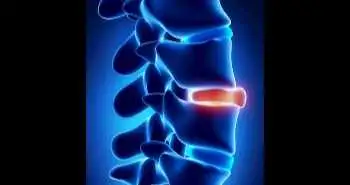 Tofacitinib: An effective and safe agent to treat ankylosing spondylitis