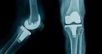 Oxford Knee Score: An independent predictor of achieving postoperative ceiling score after total knee arthroplasty