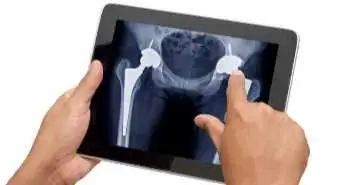 Study to evaluate short-term effects of direct anterior approach (DAA) in total hip arthroplasty