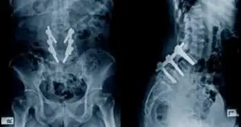 Study to evaluate the very lasting results after posterior spinal fusion with pedicular screws for adolescent