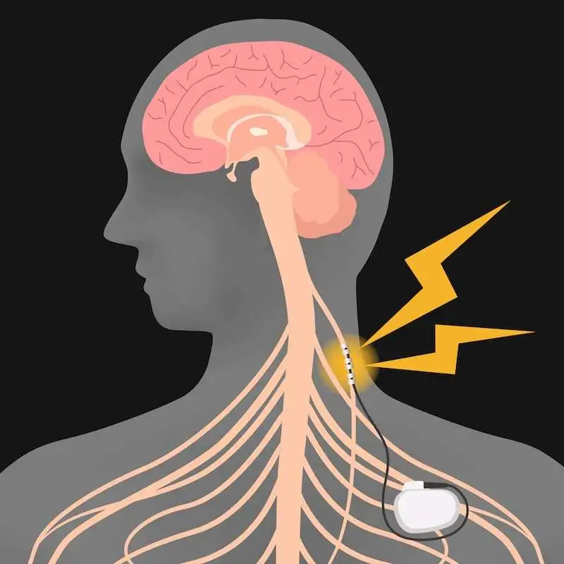 Percutaneous peripheral nerve stimulation as an alternative therapy in acute pain