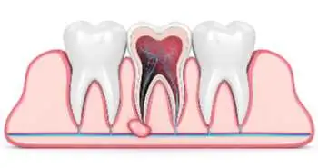 Dexamethasone found to reduce pain due to periapical abscess after 12 hours