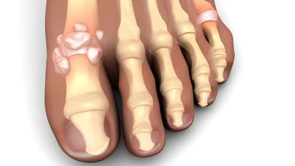 A case of chronic tophaceous gout with rare large tophi