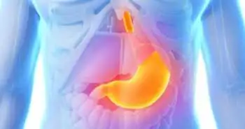 Fundoplication proved effective to treat gastroesophageal reflux