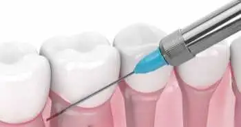 Modified periodontal anesthesia found effective and safe to treat dental caries