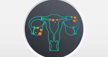 Dydrogesterone improves dysmenorrhea pain in ovarian endometrioma