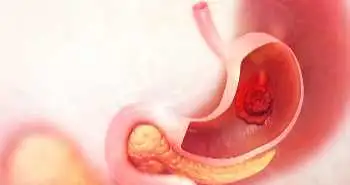 Open vs. Laparoscopic surgery for management of perforated peptic ulcer