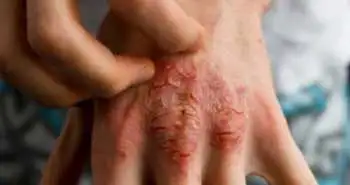 Psoriasis