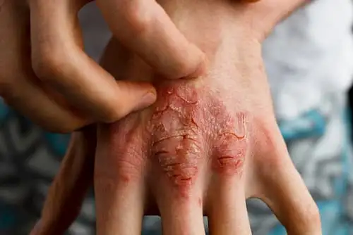 plaque.psoriasis