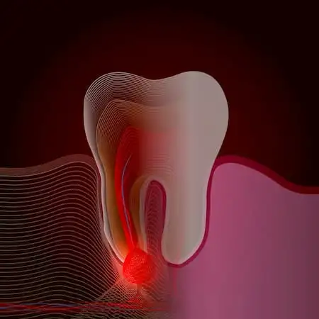 Endodontic.Pain