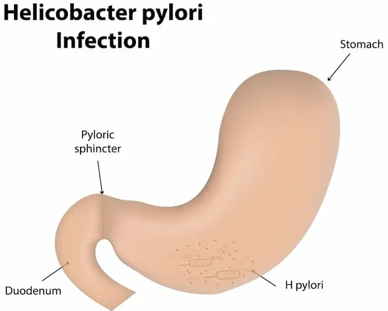 H. pylori.infection