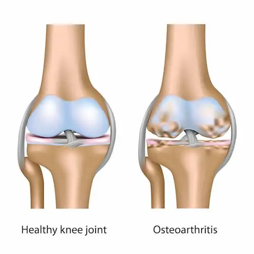 osteoarthritis