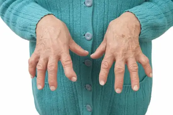 Rheumatoid_arthritis