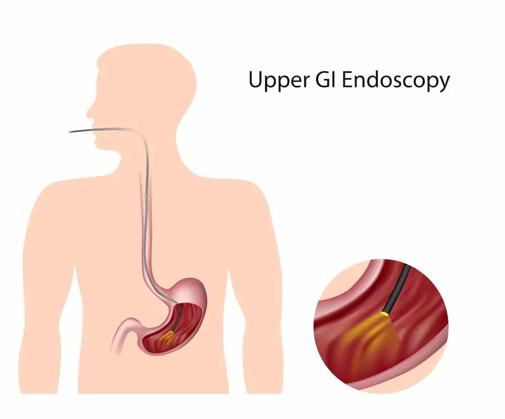 Endoscopic_pyloromyotomy