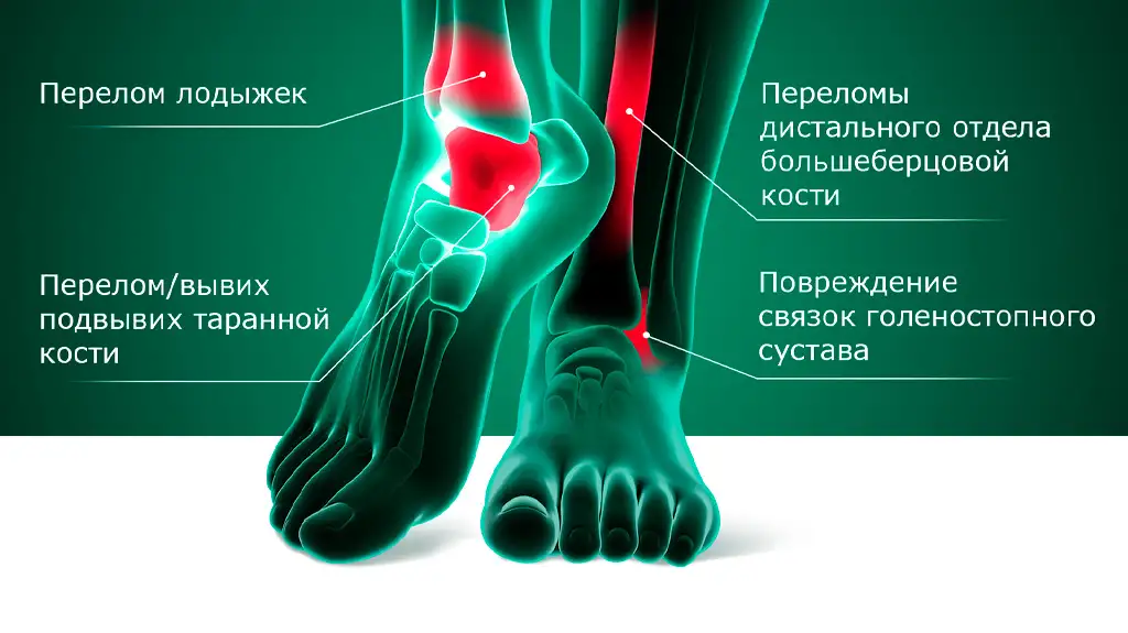 Травмы голеностопного сустава