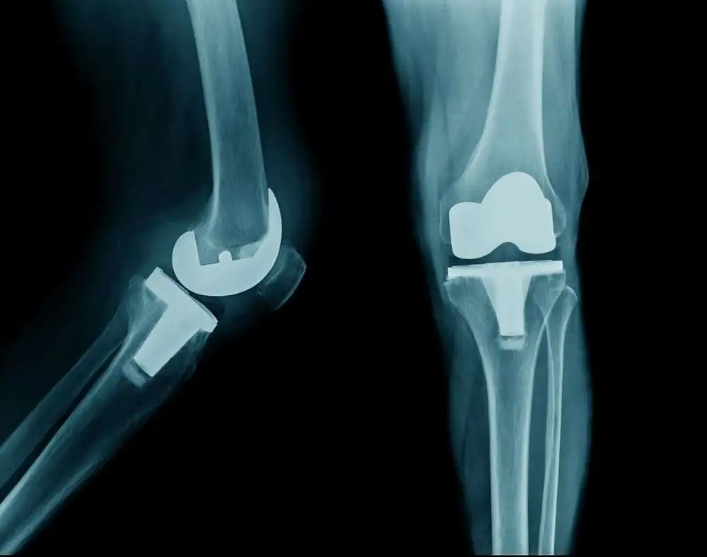 Aspartic acid racemization reveals a high turnover state in knee compared with hip osteoarthritic cartilage