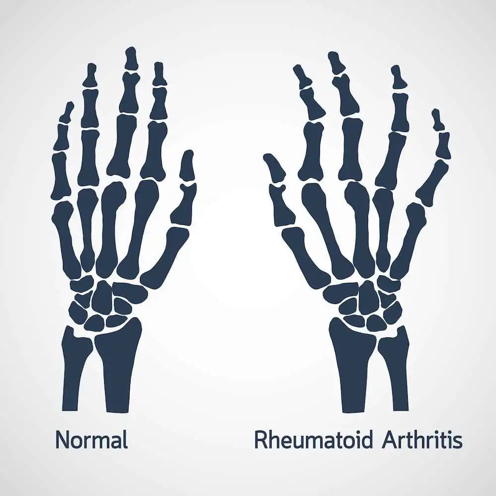 Protective effects of Folate supplementation in rheumatoid arthritis (RA) patients on Methotrexate (MTX) therapy