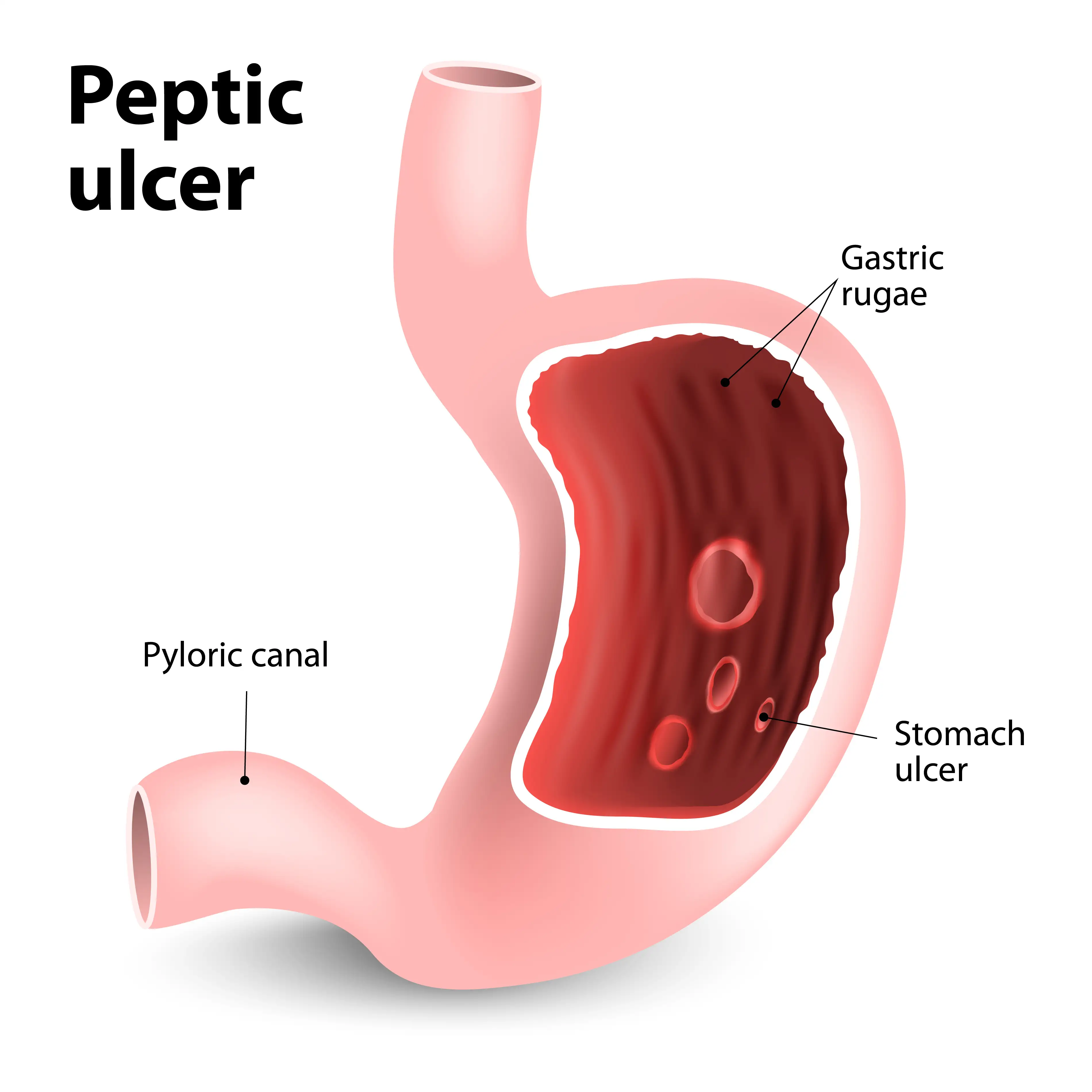 duodenal ulcer