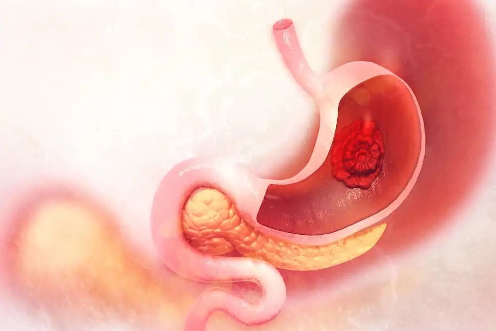 Duodenal ulcer