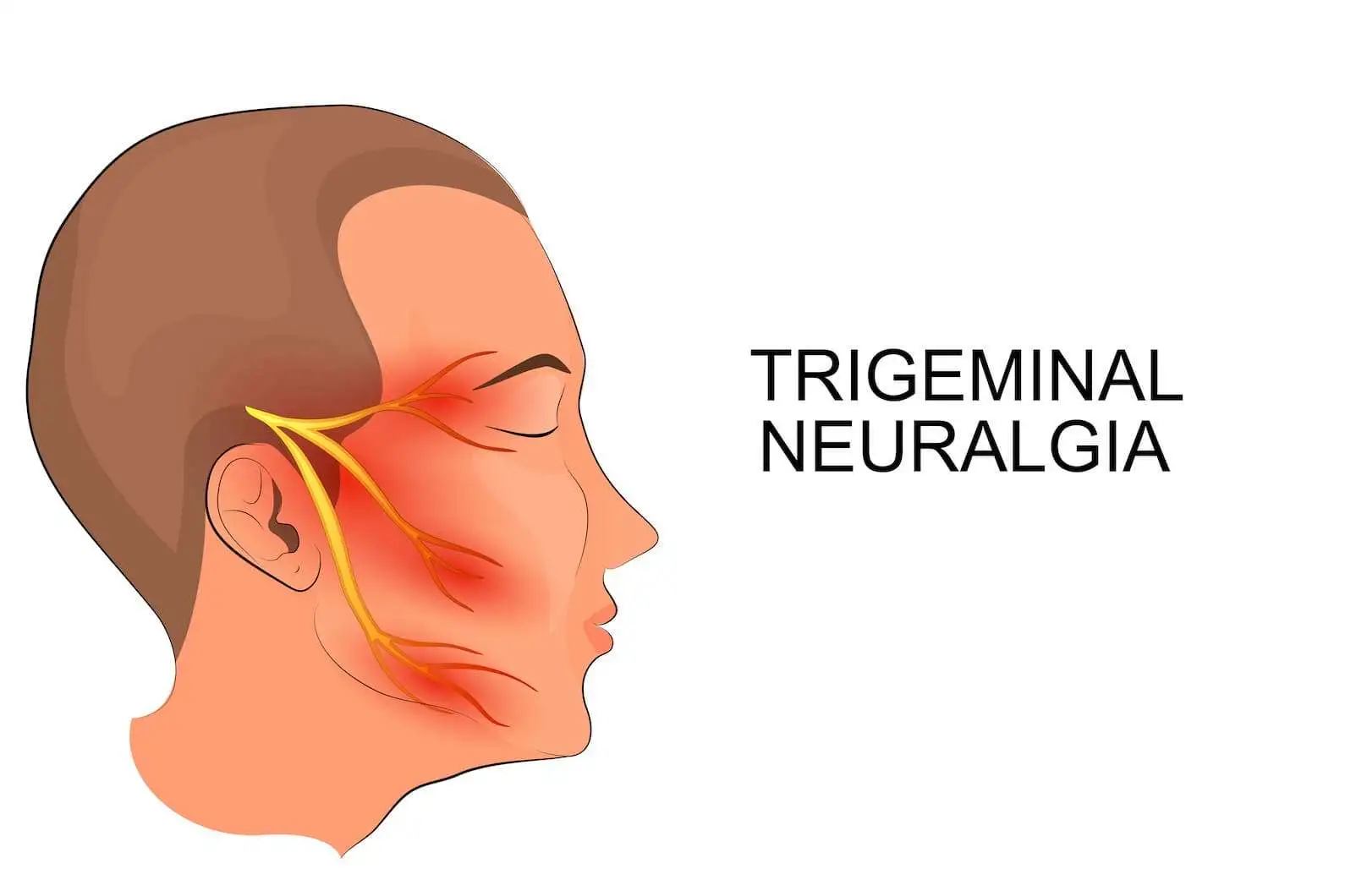 Subcutaneous trigeminal nerve field stimulation for refractory trigeminal pain: a cohort analysis