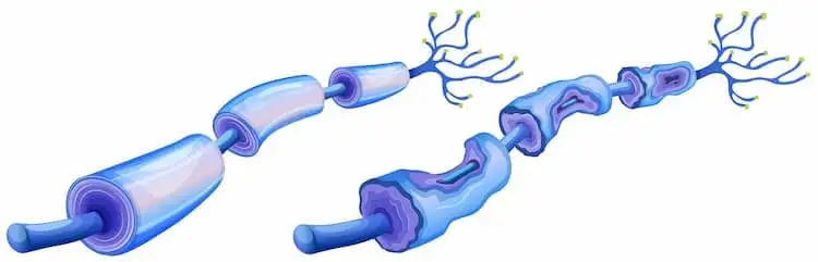 Charcot-Marie-Tooth Disease