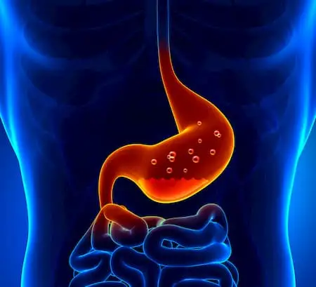 Chronic erosive gastritis