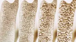 osteoporotic hemiparetic patients