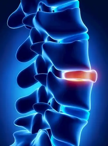 intravenous Ketorolac