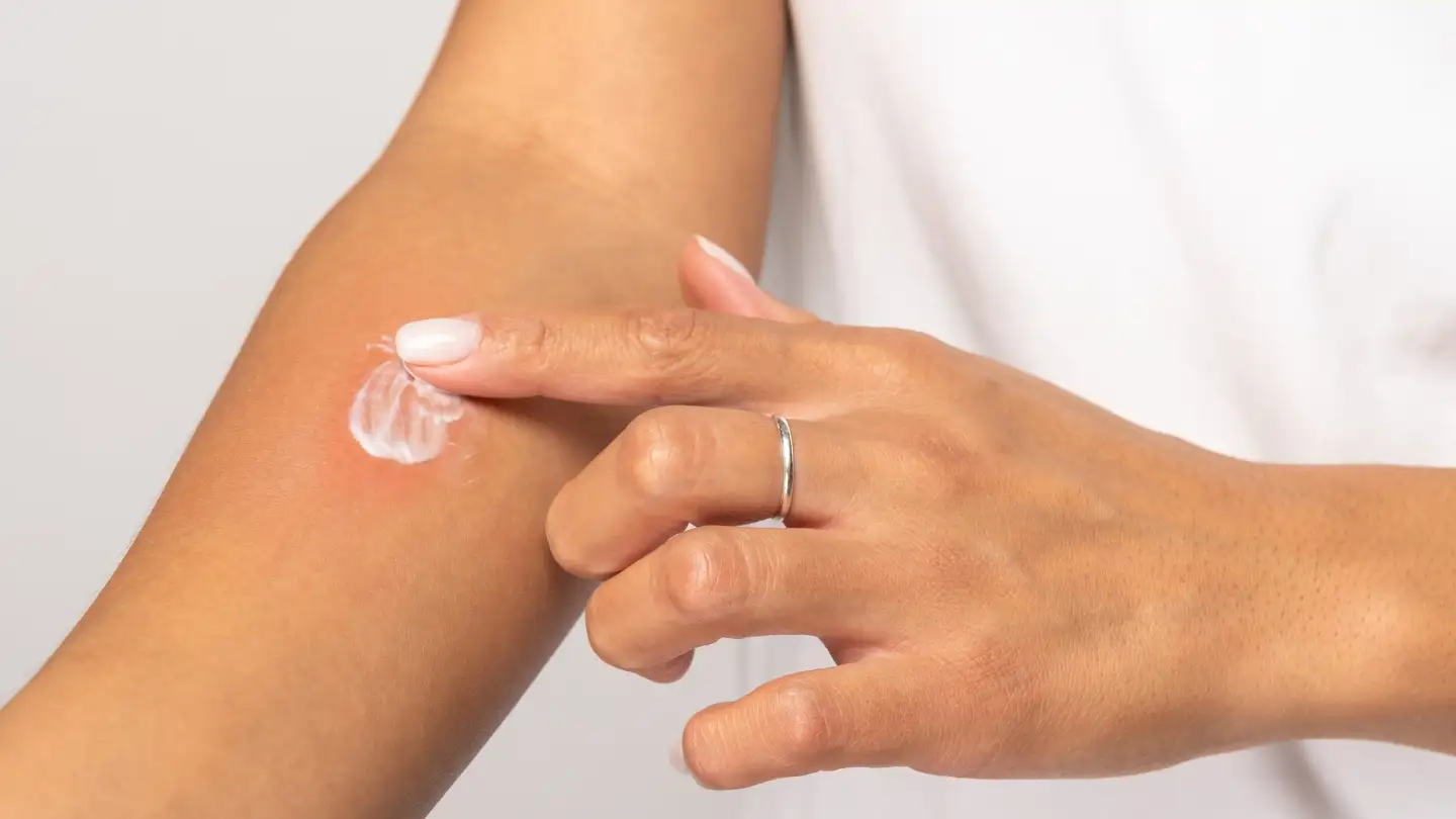 атопический дерматит Елисютина Ольга Гурьевна