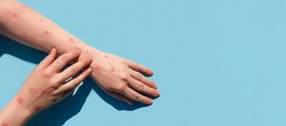 Psoriasis