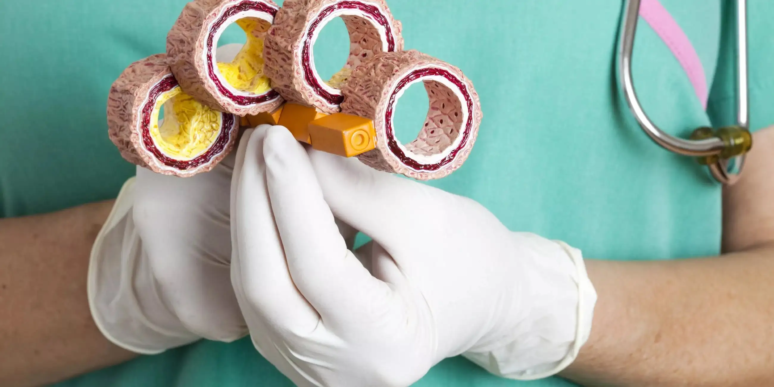 Клеточные механизмы атеросклероза, приводящего к инсульту