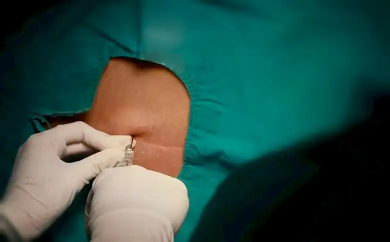 кесарево сечение