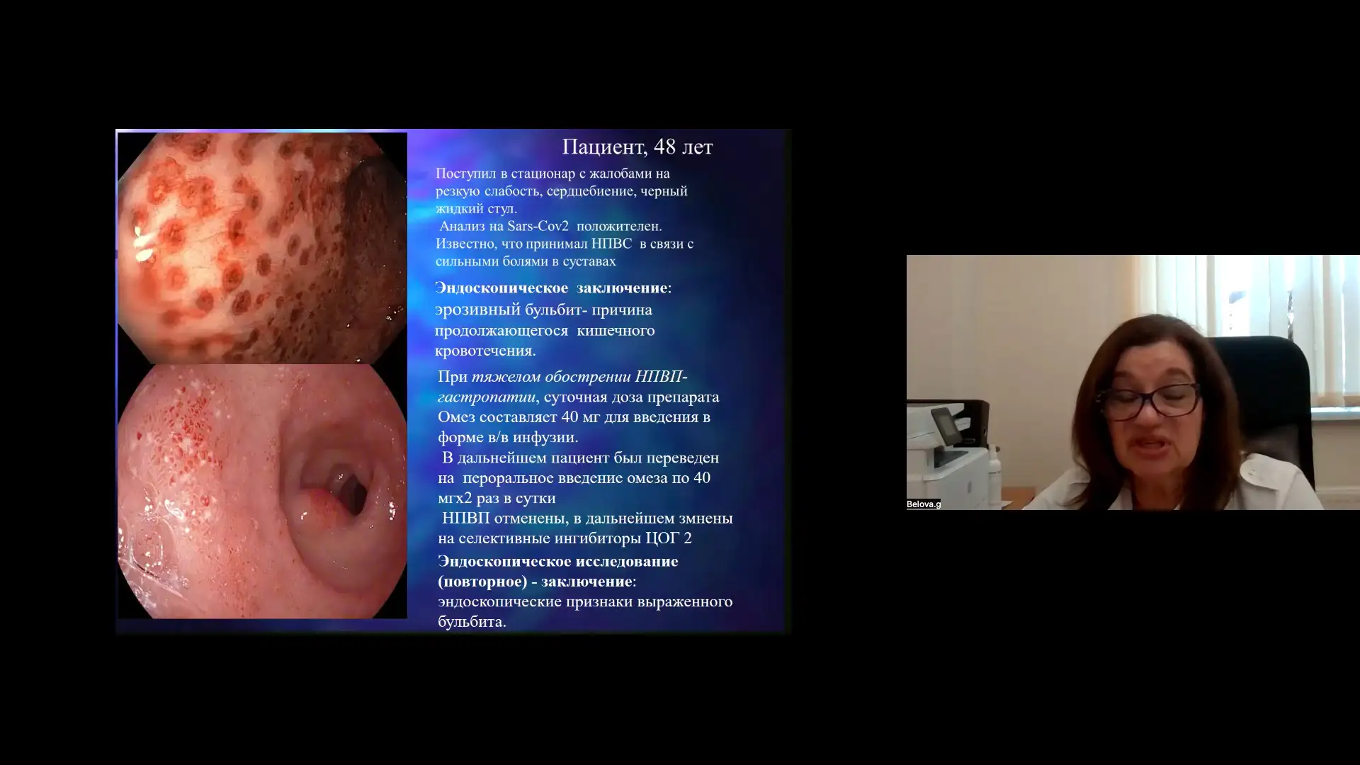 Белова ГВ Клинический случай пациента 48 лет на приеме у эндоскописта Эрозивный бульбит